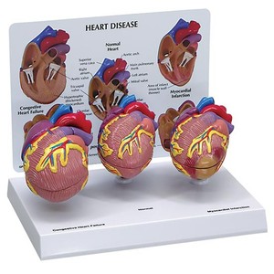 심장질환모형세트 (G255)