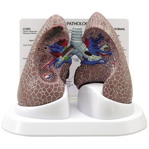 폐 - 정상폐와 흡연자의 폐 (G311)