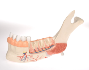 치아질환이 있는 하악모형 (VE290)